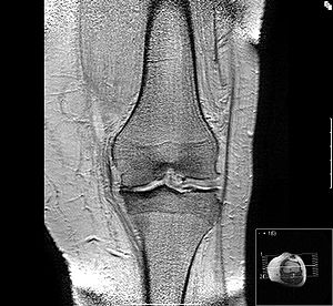 Osteoarthritis